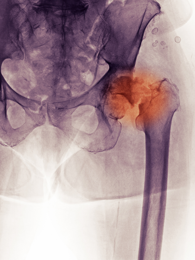 bigstock_X-ray_Of_A_Hip_Fracture_And_De_8588746