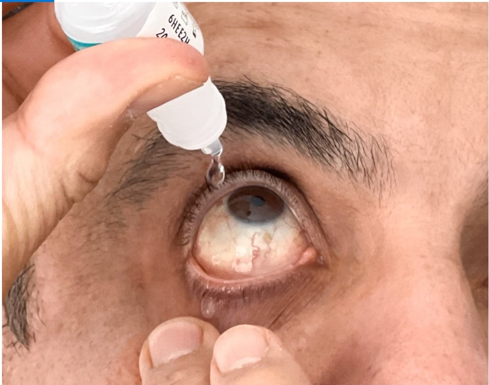 El tratamiento del glaucoma se basa en el uso de colirios.