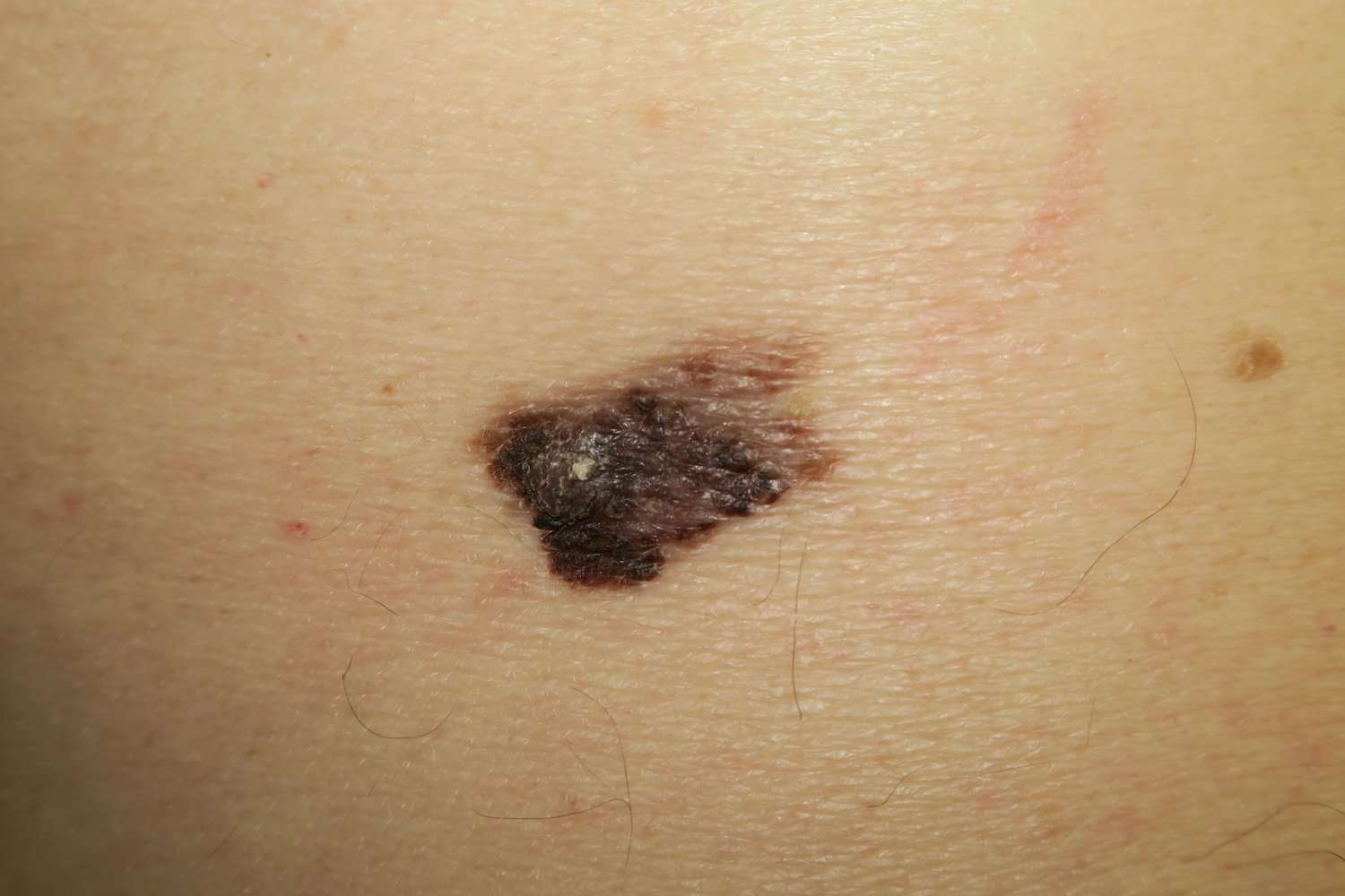 Imagen de un melanoma maligno en el brazo 